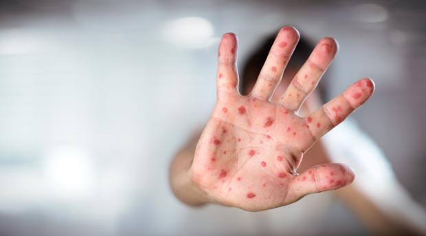El sarampión se atrinchera en Europa por los movimientos antivacunas