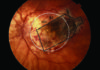 Un implante de retina frena la ceguera causada por la degeneración macular