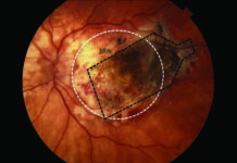Un implante de retina frena la ceguera causada por la degeneración macular