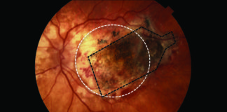 Un implante de retina frena la ceguera causada por la degeneración macular