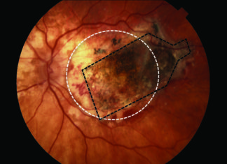 Un implante de retina frena la ceguera causada por la degeneración macular